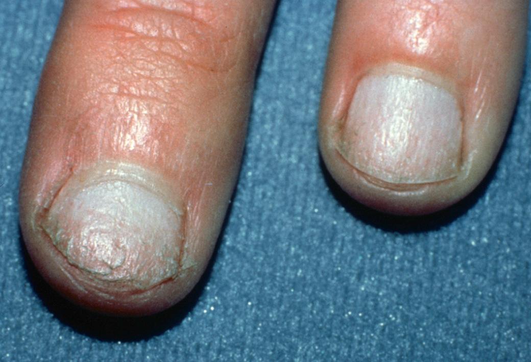 Fig. 33.2, Nails of a patient with alopecia areata.