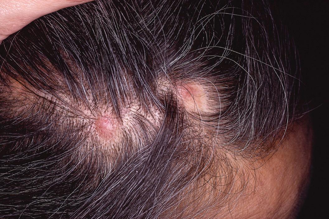 Fig. 33.21, Alopecia neoplastica.