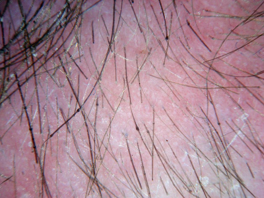 Fig. 33.24, Trichorrhexis invaginata in Netherton syndrome.