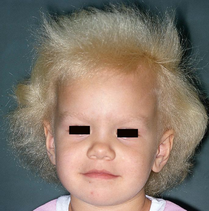 Fig. 33.26, Uncombable hair syndrome.