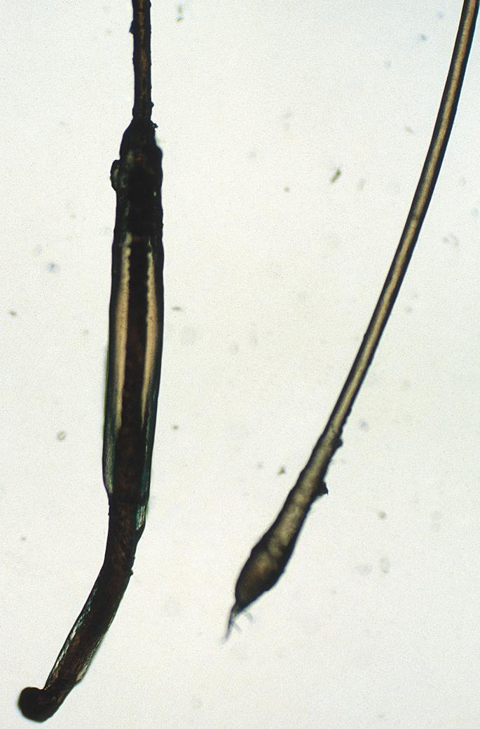 Fig. 33.3, Anagen and telogen hair. Anagen hair has a pigmented bulb and is surrounded by a gelatinous root sheath; telogen hair has a nonpigmented bulb and lacks a root sheath.