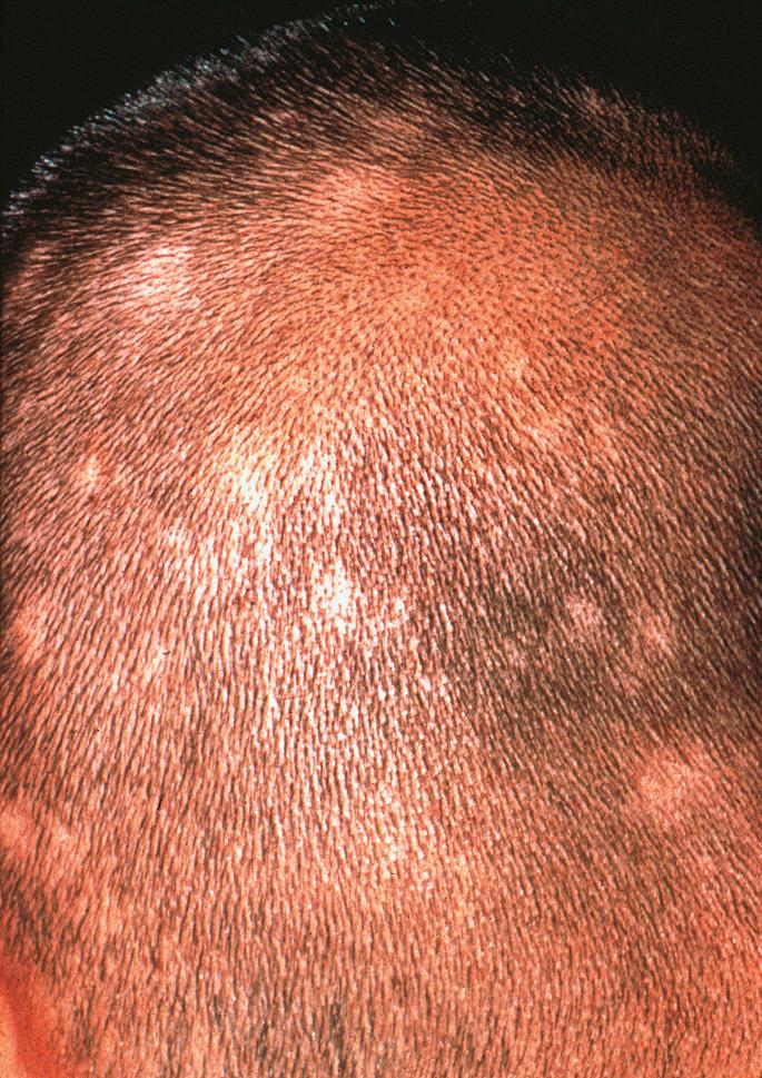 Fig. 33.7, Syphilitic alopecia.