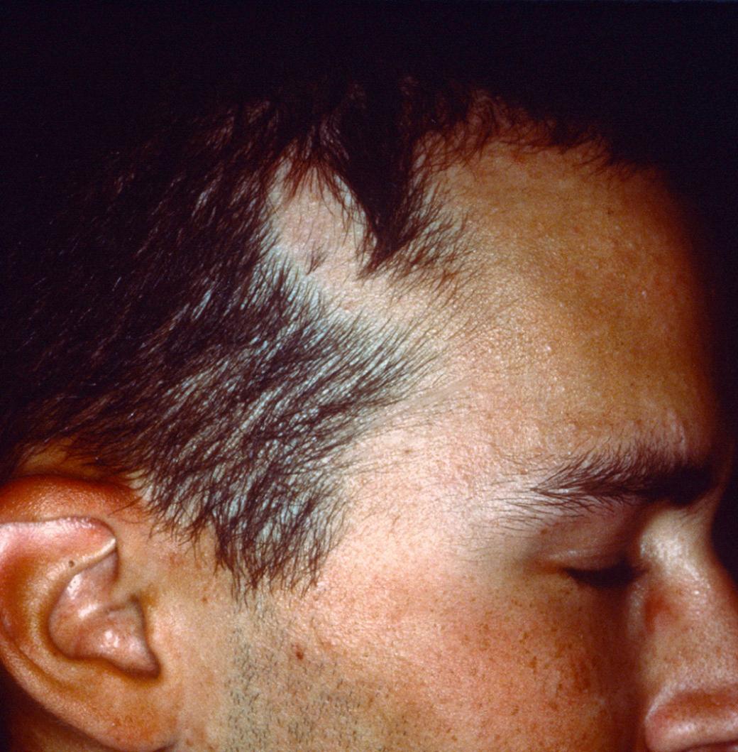 Fig. 33.8, Congenital triangular alopecia.