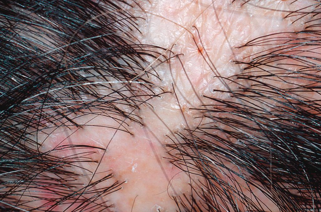 Fig. 33.9, Loss of follicular ostia in scarring alopecia.