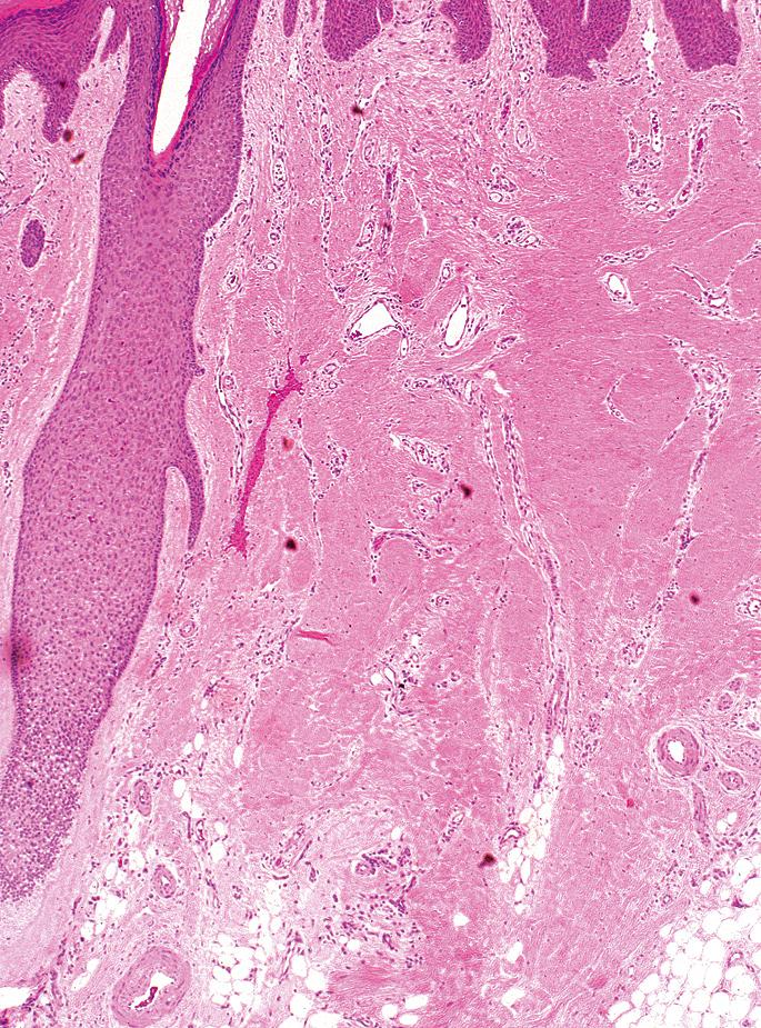 Fig. 33.10, Scarring alopecia (hematoxylin-eosin [H&E] stain).