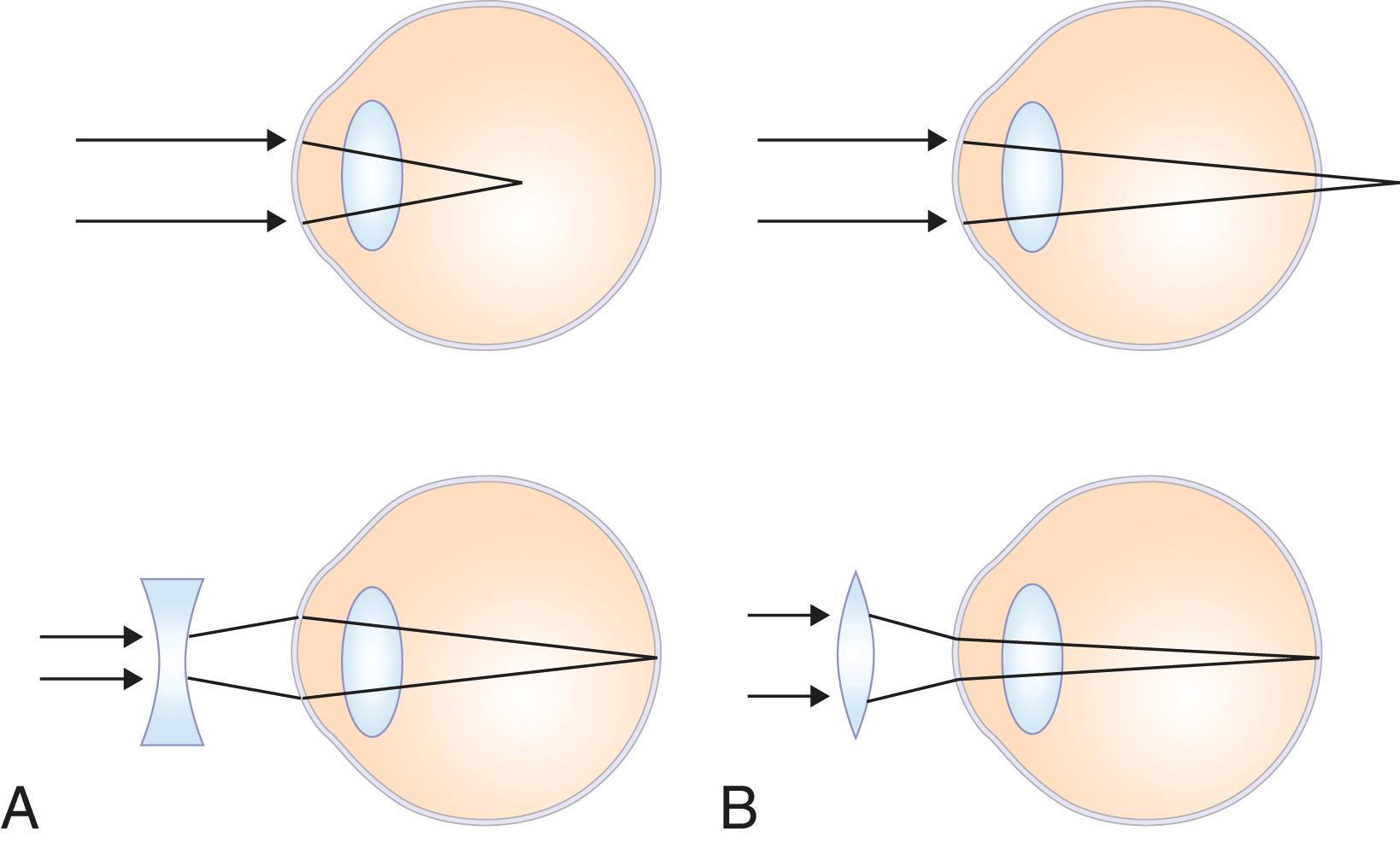 FIGURE 391-2, Myopia/hyperopia.