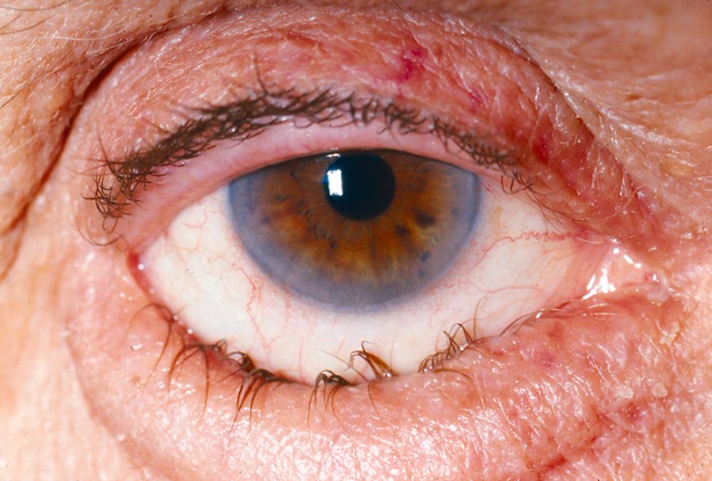 FIGURE 391-3, Involutional entropion of the lower lid with trichiasis.