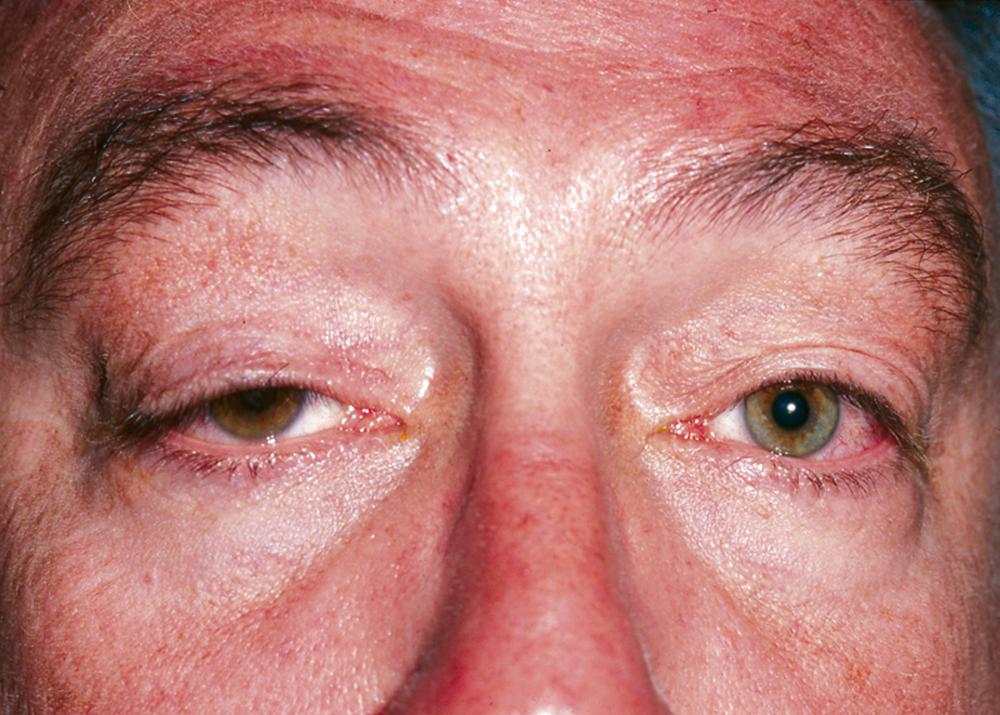 FIGURE 391-4, Ptosis of the right upper lid.