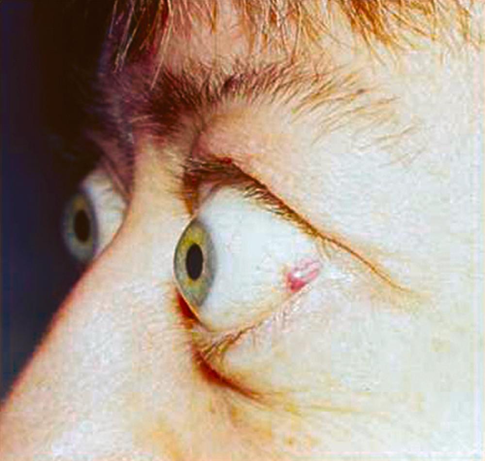 FIGURE 391-5, Thyroid eye disease (Graves) with characteristic exophthalmos and eyelid retraction.