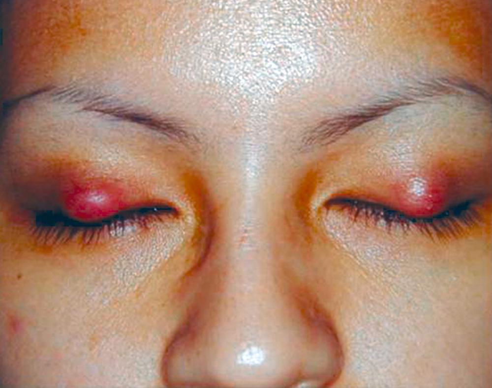 FIGURE 391-7, Bilateral chalazion in the upper eyelids.