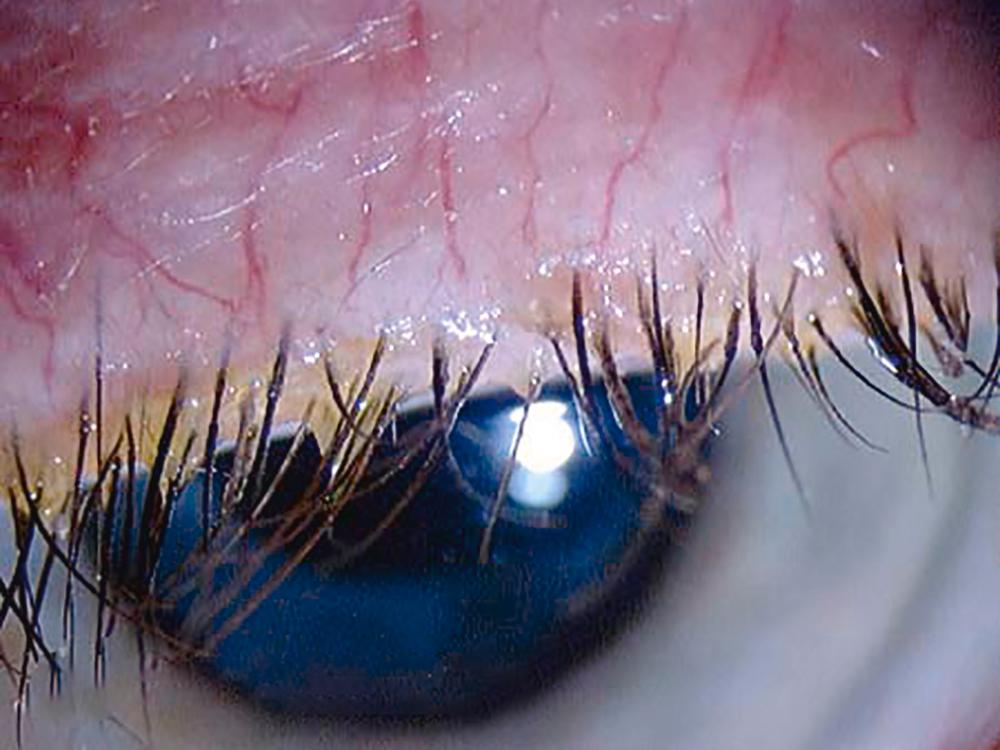 FIGURE 391-9, Blepharitis.