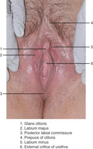 Fig. 12.1, Normal vulva showing the major anatomical landmarks.