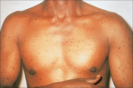 Fig. 12.103, Secondary syphilis: this patient shows a widespread hyperpigmented maculopapular eruption.