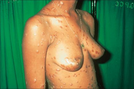 Fig. 12.104, Secondary syphilis: note the widespread papules and nodules many of which have a hypertrophic appearance.