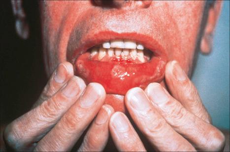 Fig. 12.110, Secondary syphilis: note the symmetrically distributed ‘snail track’ ulcers.