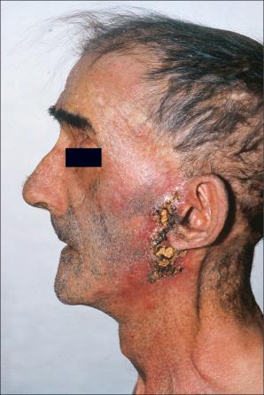 Fig. 12.114, Syphilis: the presence of gummatous cutaneous lesions as seen in this elderly male is now a very rare manifestation.