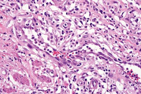 Fig. 12.116, Primary syphilis: note the marked endothelial swelling.