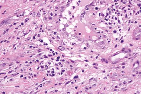 Fig. 12.117, Primary syphilis: the infiltrate consists of lymphocytes, histiocytes, and conspicuous plasma cells.