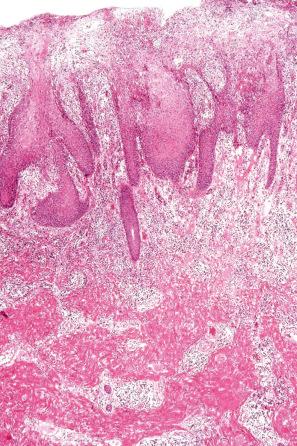 Fig. 12.118, Secondary syphilis: there is very marked hyperkeratosis and parakeratosis. The epidermis shows psoriasiform hyperplasia. A dense inflammatory cell infiltrate is present in the lamina propria. This specimen comes from a condyloma lata.