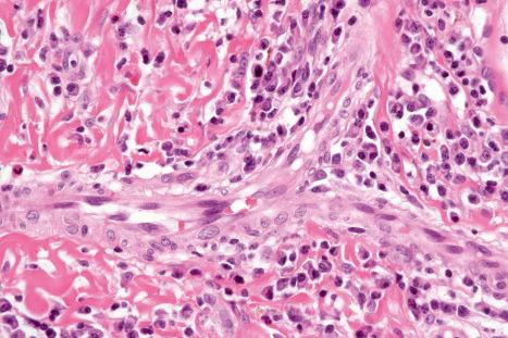 Fig. 12.119, Secondary syphilis: the infiltrate contains large numbers of plasma cells. This specimen comes from a condyloma lata.