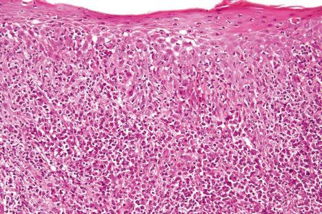 Fig. 12.121, Secondary syphilis: spongiosis is evident.