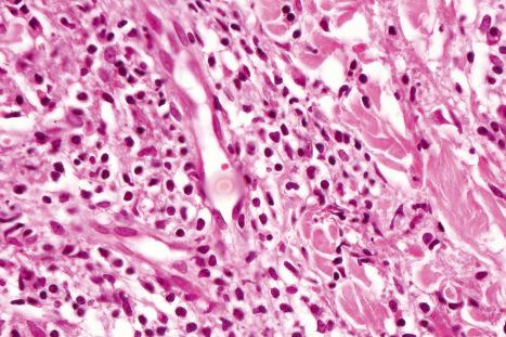 Fig. 12.123, Secondary syphilis: note the marked endothelial cell swelling.