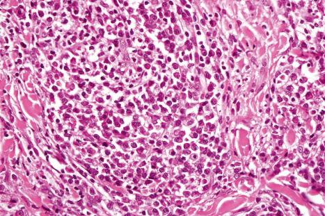 Fig. 12.124, Secondary syphilis: innumerable plasma cells are present.