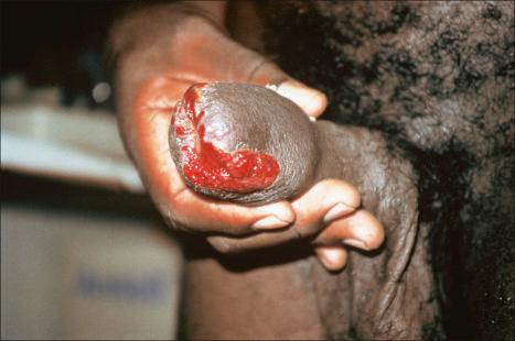 Fig. 12.128, Granuloma inguinale: in this patient, there is extensive ulceration of the glans penis. Note the typical ‘beefy’ appearance.