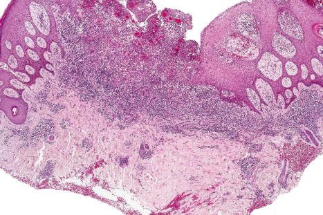 Fig. 12.129, Granuloma inguinale: biopsy from the penis. Note the pseudoepitheliomatous hyperplasia. There are intense inflammatory changes.