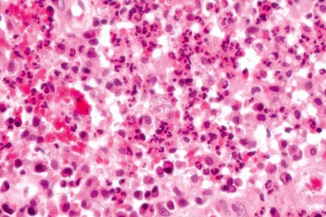 Fig. 12.130, Granuloma inguinale: the infiltrate consists of lymphocytes, neutrophils, plasma cells, and conspicuous pale-staining histiocytes.