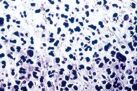 Fig. 12.134, Chancroid: note the coccobacilli growing in chains.