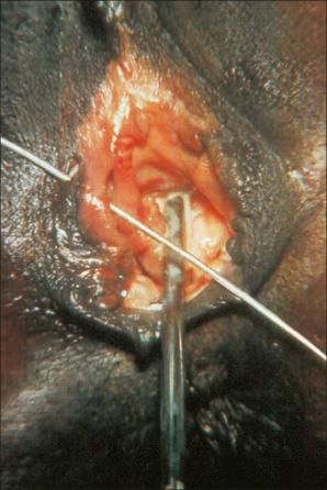 Fig. 12.135, Lymphogranuloma venereum: note the ulcer on the right labium majus.