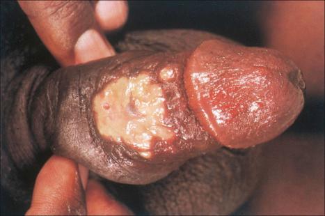 Fig. 12.136, Lymphogranuloma venereum: there is an ulcer on the penile shaft covered with necrotic debris.