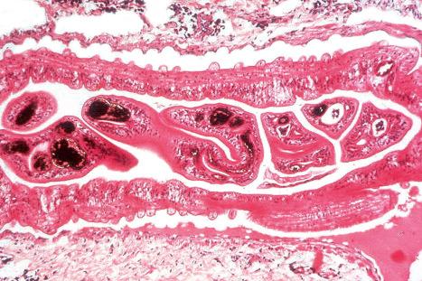 Fig. 12.139, Vulval schistosomiasis: adult worms within a dilated lymphatic; the male characteristically embraces the female in the gynecophoric canal.