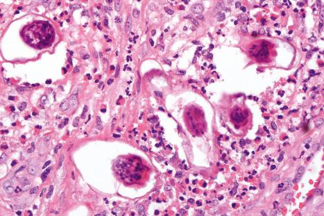 Fig. 12.140, Schistosomiasis: these ova are surrounded by a heavy infiltrate with conspicuous eosinophils.