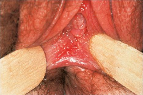 Fig. 12.14, Vestibular papillomatosis: numerous pale papillomata are present in the vestibule and on the labia minora. These are a normal finding and are particularly common in pregnancy.