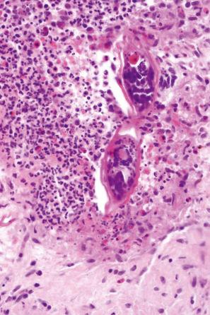 Fig. 12.141, Schistosoma hematobium: the terminal spine is characteristic of this species.