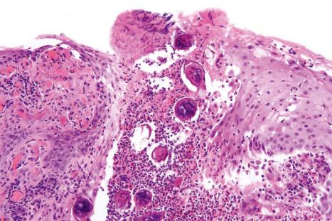 Fig. 12.142, Schistosomiasis: there is marked acanthosis. Ova are present within a breach in the epidermis.