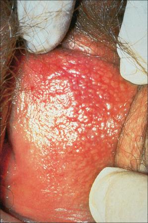 Fig. 12.15, Fordyce spots: hyperplastic sebaceous glands presenting as conspicuous yellow papules. Similar lesions may be seen on the inner lip and oral mucosa.