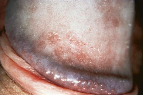 Fig. 12.24, Psoriasis: in this example a slight scale is apparent.