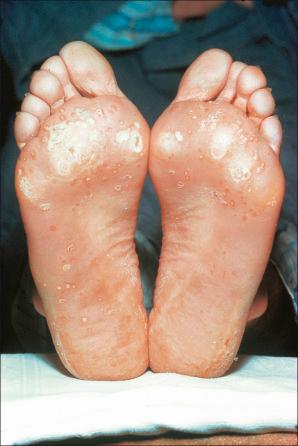 Fig. 12.26, Reactive arthritis: there are bilateral keratotic papules and plaques affecting the soles of the feet.