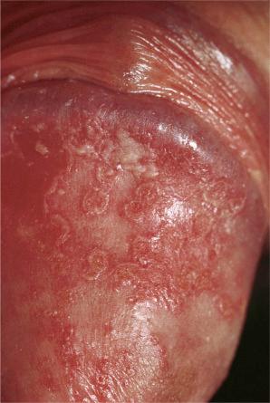 Fig. 12.28, Circinate balanitis. Glans penis. Psoriasiform lesions.