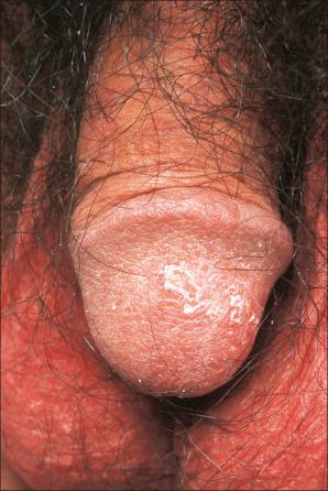 Fig. 12.30, Reactive arthritis: in this patient, there are scaly lesions on the glans penis.