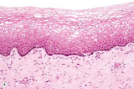 Fig. 12.3, Vestibule: ( A ) the epithelium is nonkeratinizing and rich in glycogen. Cutaneous appendages are absent at this site; ( B ) the epithelium is strongly PAS positive.