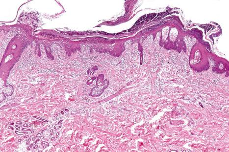 Fig. 12.31, Reactive arthritis: there is parakeratosis overlying a macropustule. The squamous epithelium shows psoriasiform hyperplasia. These features are indistinguishable from pustular psoriasis.