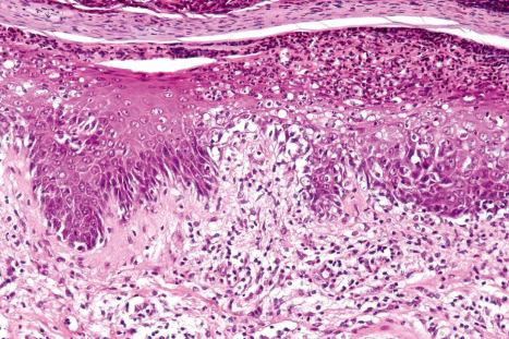 Fig. 12.32, Reactive arthritis: high-power view showing parakeratosis and a pustule.