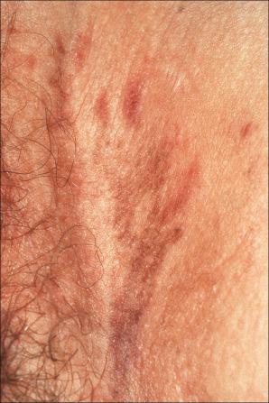 Fig. 12.36, Vulval lichen planus: in this example of resolving disease, there are linear hyperpigmented lesions.