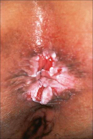 Fig. 12.37, Perineal lichen planus: typical papules with Wickham striae are present.