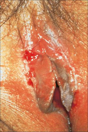 Fig. 12.41, Erosive lichen planus: bilateral erosions are present.