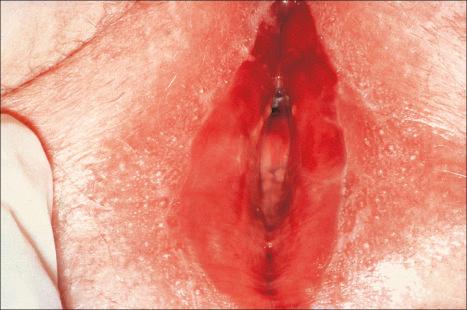 Fig. 12.42, Vulvovaginal-gingival syndrome: there is extensive vestibular erythema and erosion with a surrounding delicate white scale.